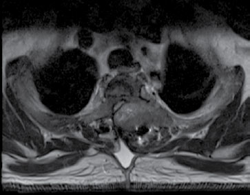 Figura 1. Corte transversal con secuencia T2: se observa lesión que compromete el cuerpo vertebral y los elementos posteriores principalmente del lado izquierdo, causando disminución severa del canal