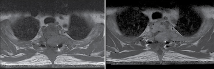 Figura 2. Secuencia T1: imagen de la derecha sin contraste, imagen de la izquierda con contraste. Nótese cómo la masa se realza con medio de contraste, lo que evidencia interrupción de la membrana basal