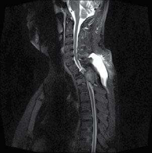 Figura 4. Secuencia STIR: supresión de la grasa; se aprecia que la masa no desaparece en esta proyección, lo que demuestra que la masa no es de componente graso