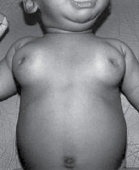 Figura 1. Crecimiento gigante de los senos en un recién nacido, que algunos llaman “Mastauxe” (del griego, mastos: senos y auxein: aumento de tamaño)