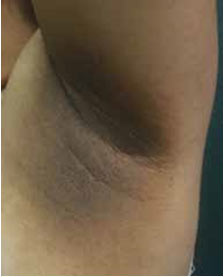 Figura 4. Placas pardas claras de aspecto aterciopelado bien definidas que ocupan el 80% de tejido celular subcutáneo en región cervical posterior y axilar