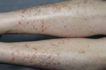 Figura 5. En ambos miembros inferiores se evidencian múltiples papilas xantomatosas con borde eritematoso, que ocupan el 60% de la pierna