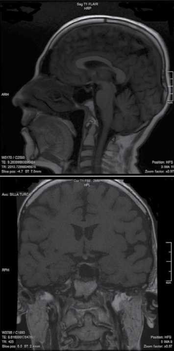 Figura 1. Ectopia hipofisaria posterior con neurohipófisis