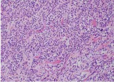 Figure 1. The tumor is composed of discohesive spindle and epithelioid cells in nests (200X)