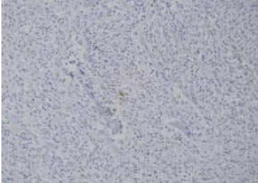 Figure 2. There are foci of weak positivity with a calcitonin immunostain (400X)