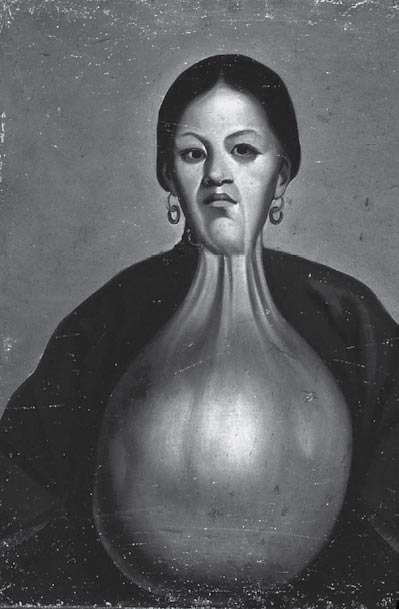 Figura. 1. Bocio. Obra de la pintora china Lam Qua (fechada en la década de 1830) que retrata a una paciente del hospital de Cantón, China, quien presenta un bocio gigante.