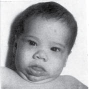 Figura 4. Niño con cretinismo