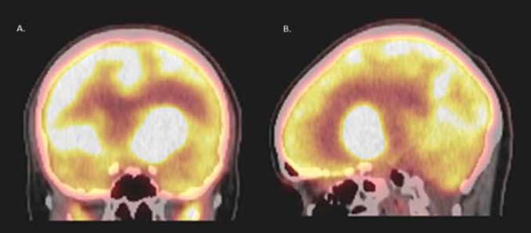Figura 1. PET/CT (tomografía con emisión de positrones con radiofármaco f-18 FDG