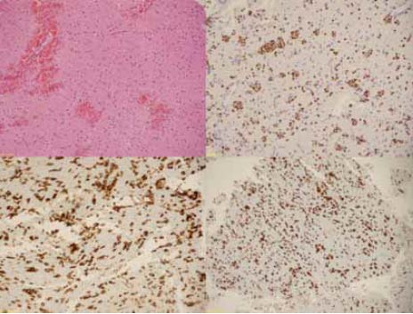 Figura 2. Reporte histopatológico de biopsia cerebral región núcleo basal izquierda