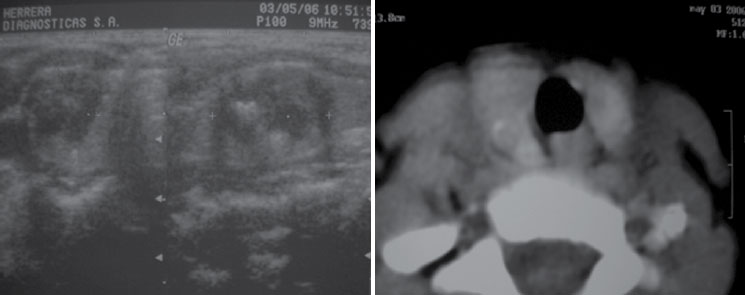 Figura 1. Ecografía y tomografía: masa sólida con calcificaciones