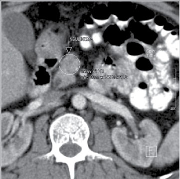 Figura 1. TAC abdomen contrastado