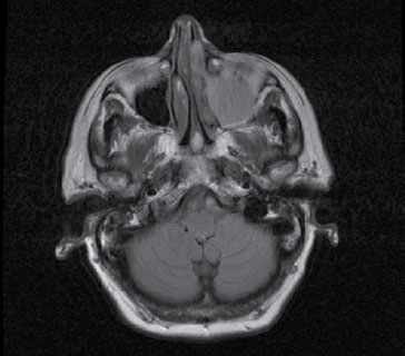 Figura. Corte horizontal TAC