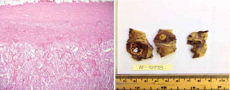 Figura 2. Paciente de 46 años sexo masculino quien presenta dolor abdominal. En estudios de imagen se encontró la presencia de una masa adrenal de 92 por 55,4 por 54 mm. Las catecolaminas en orina demostraron una producción elevada de adrenalina (162,97 mcg/24 horas, valor de referencia 0-20). Las metanefrinas totales en orina también estaban elevadas (2,71 mg/24 horas, valor de referencia 0-1 mg/24 horas). Se realizó adrenalectomía y se confirmó un feocromocitoma. La primera imagen corresponde a una tinción con hematoxilina-eosina con un aumento 100 x