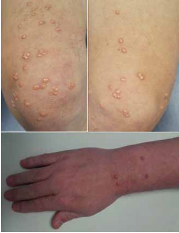 Figura 1. Lesiones compatibles con xantomas eruptivos en rodillas y antebrazo