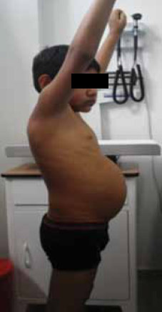 Figura 2. Examen físico: Abdomen globoso y hepatomegalia