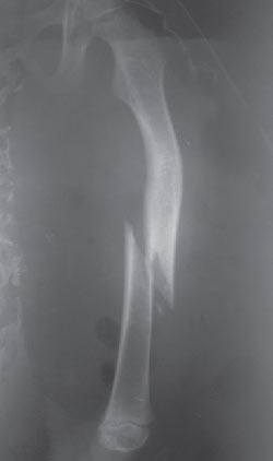 Figura 1. Fractura de fémur izquierdo