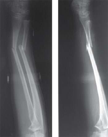 Figura 2. Fractura de radio y cúbito izquierdos