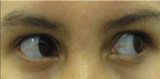 Figura 3. Escleras azules en paciente madre