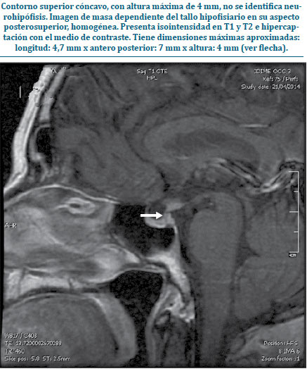 Figura 1. RMN de silla turca contrastada