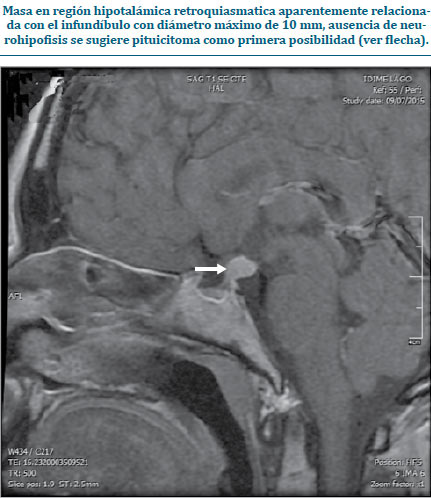 Figura 2. RMN de silla turca contrastada