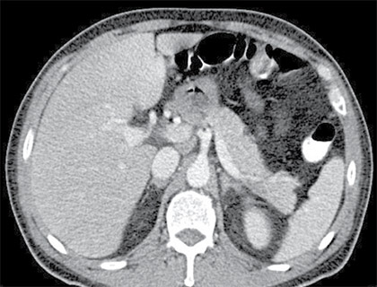 Figura 1. Tomografía de abdomen contrastado.