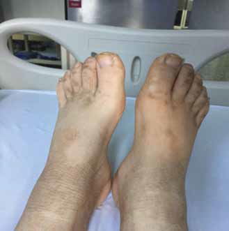Figura 1. Acantosis en localización atípica, dorso de pies.