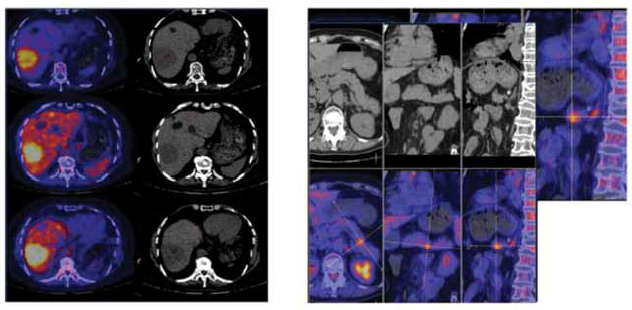 Figura 2. Imágenes de PET – CT con 18 FDG
