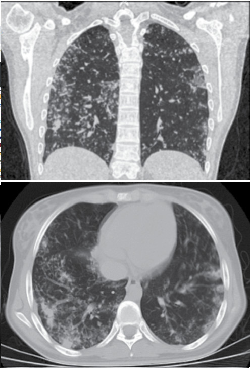 Figuras 2 y 3. TAC de tórax