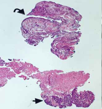 Figura 5. Hematoxilina eosina 4x. Se observa biopsia
