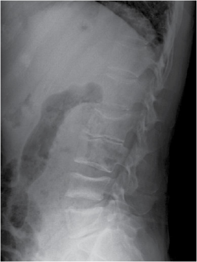 Metabolismo óseo, osteoporosis y enfermedad inflamatoria intestinal en ...