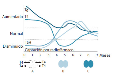 Figura 4. Patrón clásico de la tiroiditis