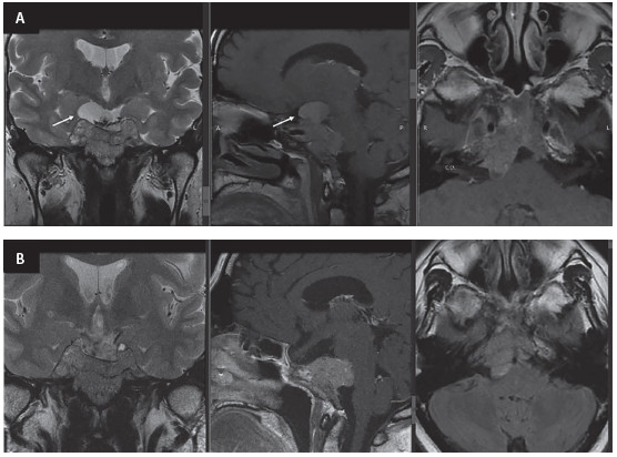 Figura 2. A. RM (2017), corte coronal secuencia T2, corte sagital secuencia T1 contrastado, corte axial secuencia T1