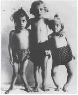 Figura 1. Tres niños con raquitismo.