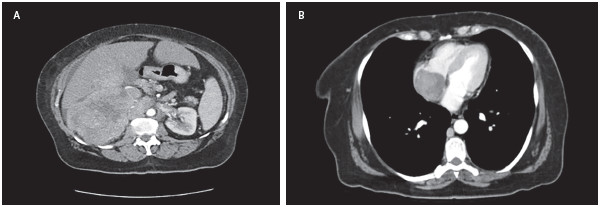 Figura 1. A. Tomografía axial computarizada de abdomen contrastado. B. Tomografía