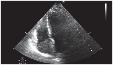 Figura 2. Ecocardiograma transtorácico. Vista apical