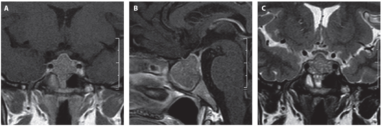 Figura 1. Resonancia de hipófisis previa al inicio del tratamiento. A. Secuencia T1 contrastada, corte coronal. B. Secuencia T1 contrastada, corte sagital. C. Secuencia T2, corte coronal. Se identifica una masa cuyo diámetro era de 24
