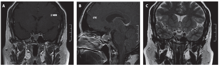 Figura 2. Resonancia de hipófisis posterior al manejo. A. Secuencia T1 contrastada, corte coronal. B. Secuencia T1 contrastada, corte sagital. C. Secuencia T2, corte coronal. Tamaño tumoral residual con diámetros: 16 mm anteroposterior