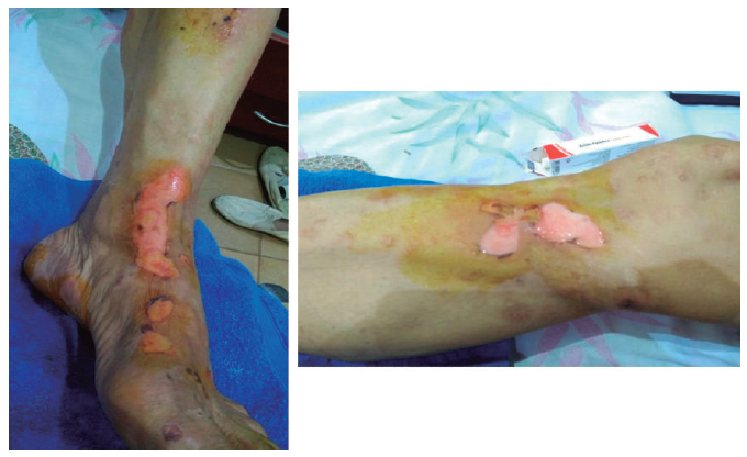 Figura 1. Caso 1. Aspecto de las lesiones una vez que las ampollas se han roto. La coloración amarillenta es por la crema utilizada por el paciente.