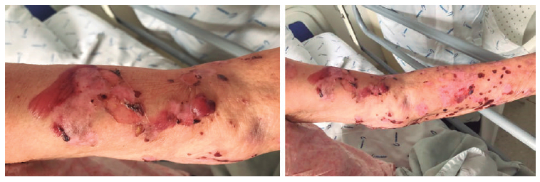 Figura 2. Caso 2. Se aprecian lesiones ampollosas en diferentes fases evolutivas hacia la mejoría.