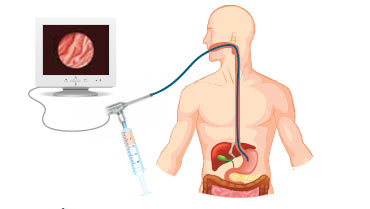 Figura 6. Implantación de islotes pancreáticos en la submucosa gástrica por medio de endoscopia digestiva alta