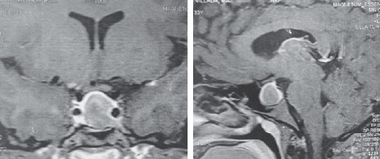 Figura 1. RMN de silla turca con contraste. a) Corte sagital en T1. b) Corte coronal en T1