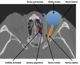 Corte coronal de TC de senos paranasales con su- perposiciones en color