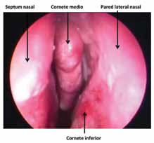 A. Visión preoperatoria.