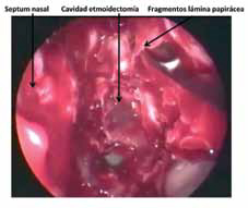 B. Una cureta es utilizada para fracturar