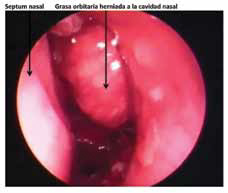 D. Grasa orbitaria herniada hacia la cavidad nasal.